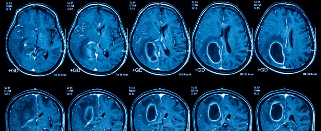 Exámenes para la Detección de Tumores Cerebrales