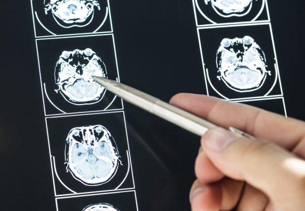 Operación de Cavernoma
