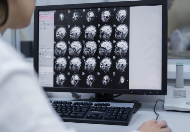 Cavernoma Cerebral