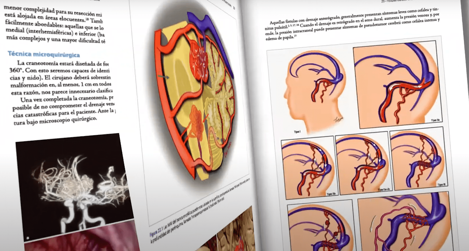 Neurocirugía