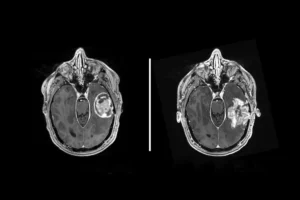 Día Internacional del Glioblastoma