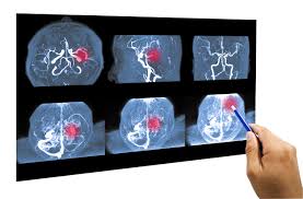 cirugia para aneurisma cerebral