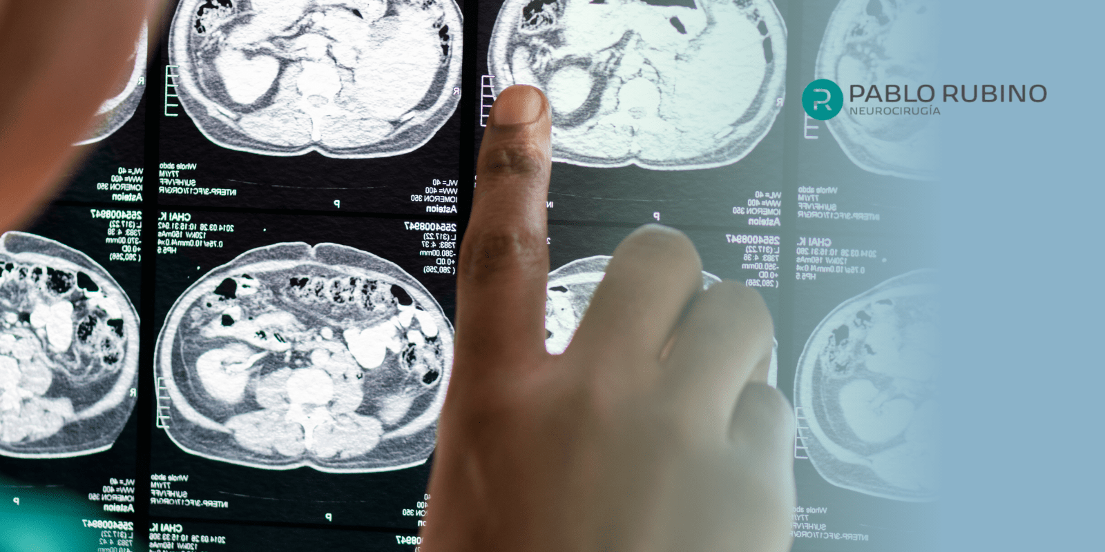 Cavernoma en el tronco cerebral: Síntomas y diagnóstico